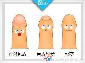 男人包皮过长该如何解决？—九江男科医院