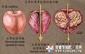 前列腺偏大怎么治疗_九江医大医院