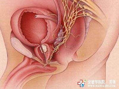 男性前列腺增生怎么办-九江医大医院