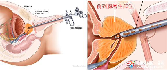 前列腺增生什么技术可以为男性排忧——九江医大医院