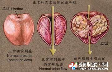 前列腺肥大如何治疗效果好?