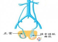 精索静脉曲张男性不育的“头等杀手”