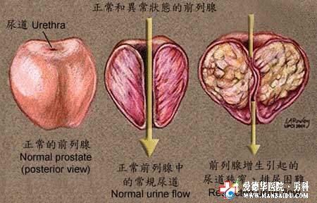 前列腺增生出现血尿怎么办？—九江医大医院