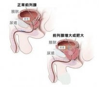 前列腺肥大