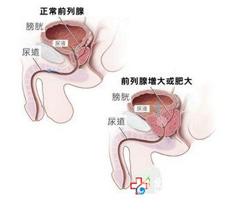 前列腺增生