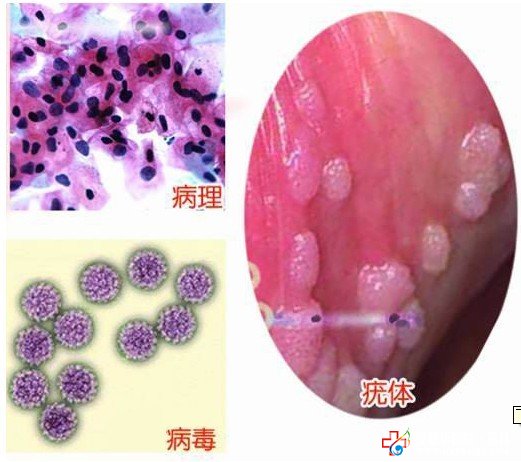 防复发是治愈尖锐湿疣的关键