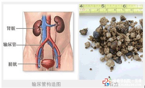 膀胱结石的危害如何