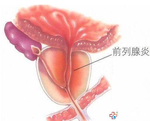 引起细菌性前列腺炎反复发作的原因