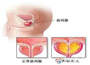 治疗前列腺增生什么技术可以治愈？—九江男科医院