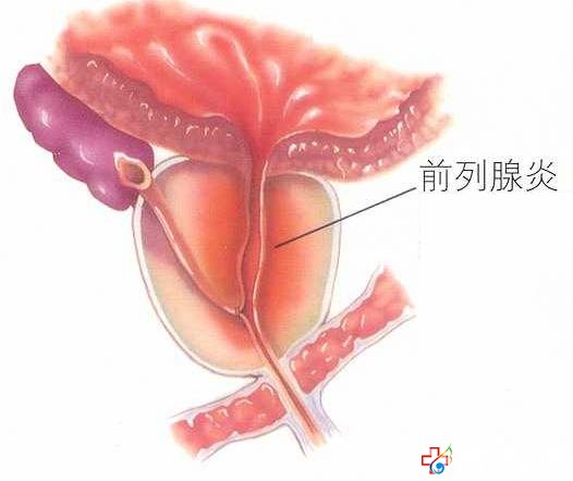 怎样治疗急性前列腺炎好-邯郸男科医院