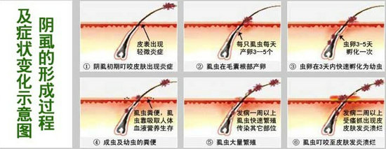 阴虱是怎么回事？男性阴虱怎么办