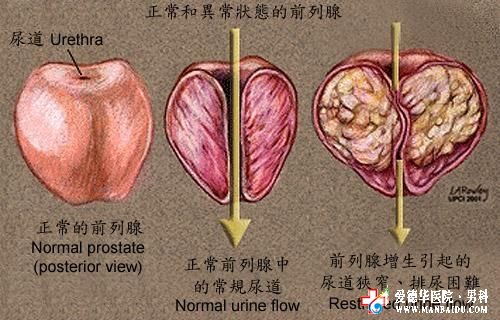 九江专治前列腺增生医院—九江医大医院