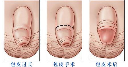 老年人包皮过长究竟用不用做手术